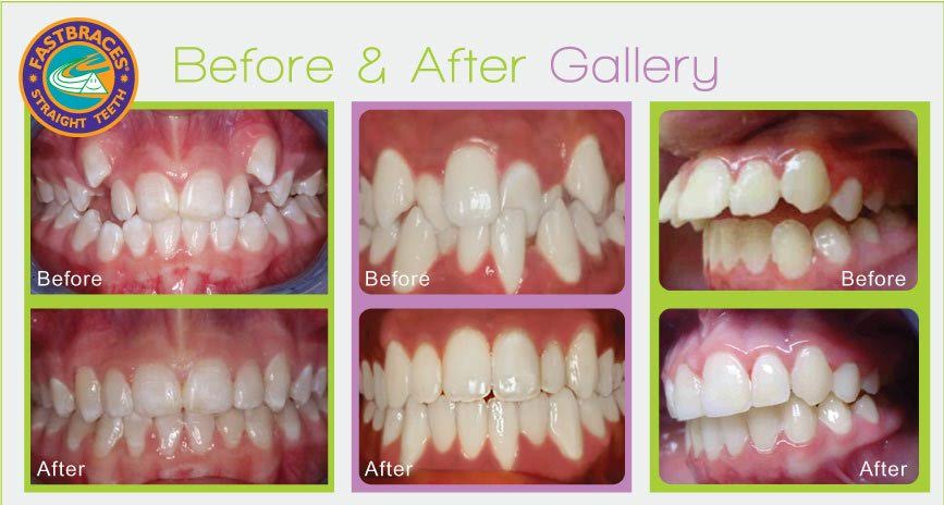 FastBraces in Wexford