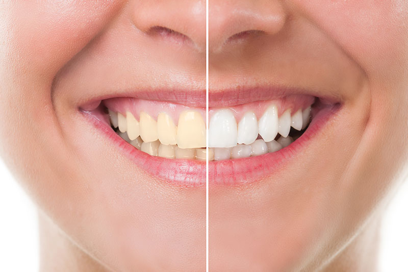 teeth-whitening